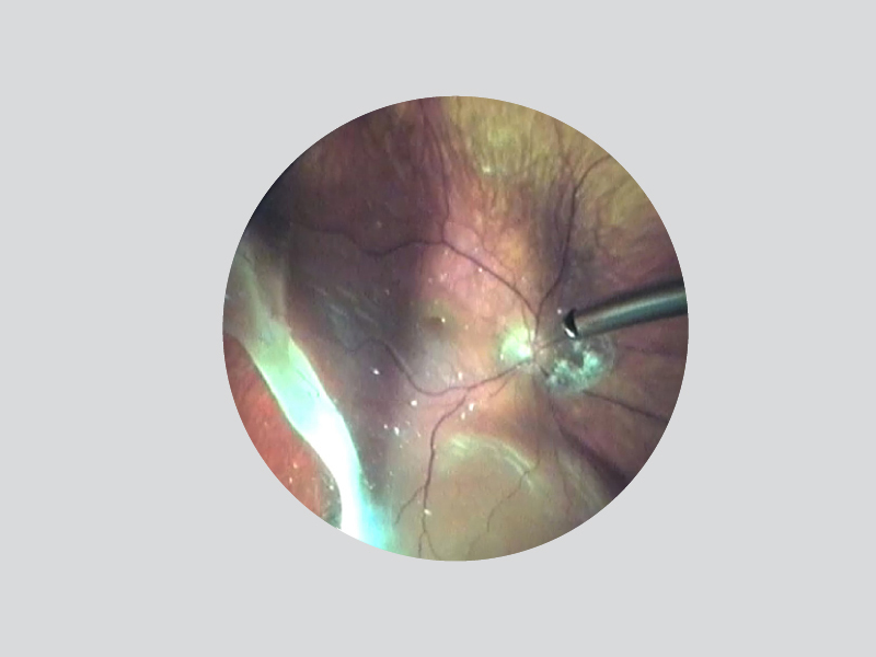 HD clarity under high magnification reduces the need for a contact lens.